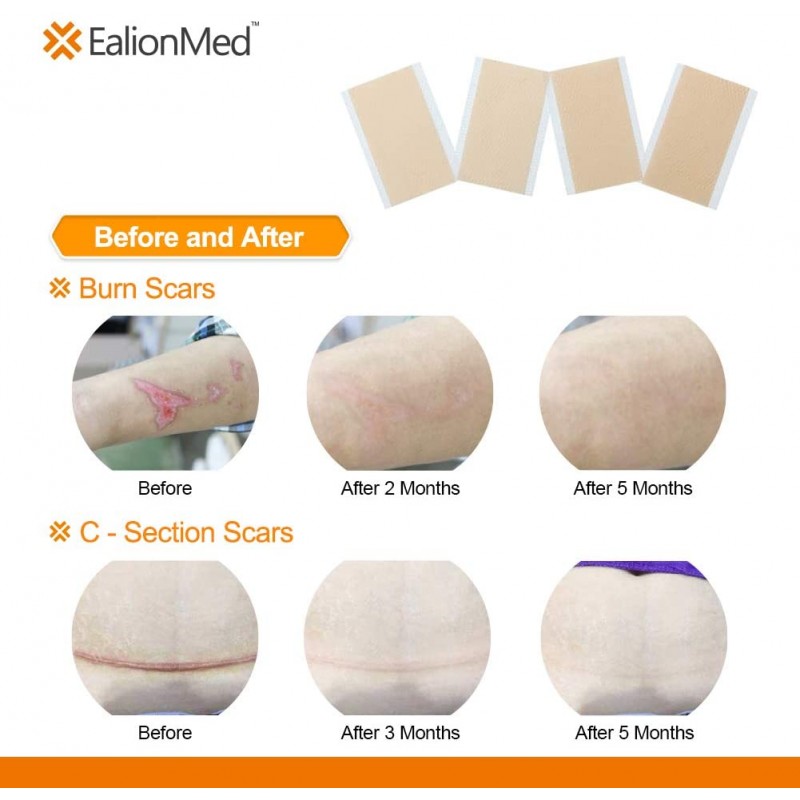 EalionMed 실리콘 시트, 비대성 , 켈로이드 , C 섹션  3``x 1.6 ''8 시트 팩에 대한 