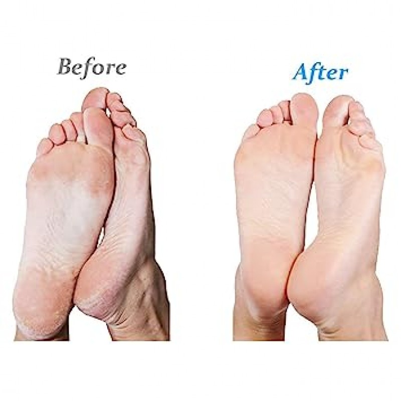 엠조이 마이크로페디 캘러스 리무버