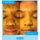 어드마이어 마이 스킨 다크 스팟 코렉터 리무버 포 페이스 - 브라이트닝 변색 코렉팅 세럼 - 시노베아, 코직산, 비타민 C, 살리실산, 젖산 세럼이 함유된 멜라스마 트리트먼트 크림