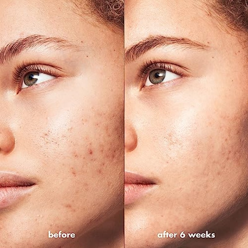 꼬마 요정. SKIN Blemish Breakthrough 삼중산 재포장 세럼, 여드름 퇴치를 위한 하이드레이팅 나이트 세럼, 나이아신아마이드로 제조, 비건 및 동물 실험을 하지 않음