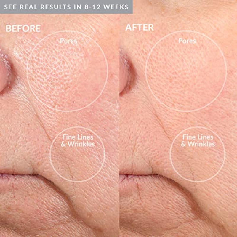 PMD Personal Microderm Pro - 얼굴 및 신체용 키트가 포함된 가정용 미세 박피 기계 - 산뜻하고 빛나는 피부를 위한 각질 제거 크리스탈 및 진공 흡입 - 고속 및 저속 옵션