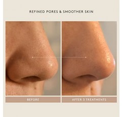 SHANI DARDEN SKINCARE 트리플 애시드 필, 피부 각질 제거 및 모공 개선을 위한 표면 재포장 필, 1.69 fl oz