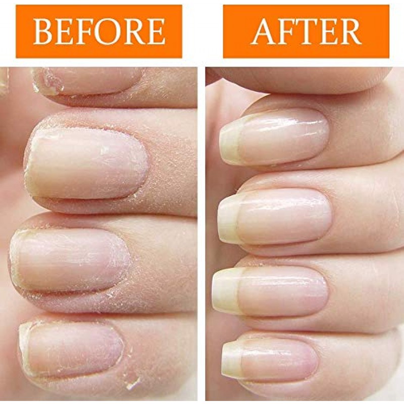 Nail Tek Repairs 손상된 네일 키트. 인텐시브 테라피(.5OZ), 파운데이션(.5OZ) 및 리뉴(.48OZ)