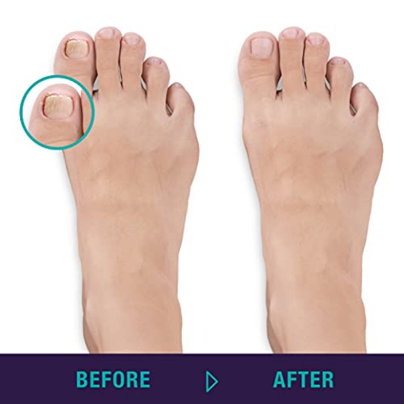 TRIM Simply Foot Ingrown Toenail Kit – 스테인레스 스틸 발톱 니퍼 및 스테인레스 스틸 듀얼 엔드 파일 포함 – 사용하기 쉬운 발 관리 도구 – 남성 및 여성용 – 실버 – 2피스 세트