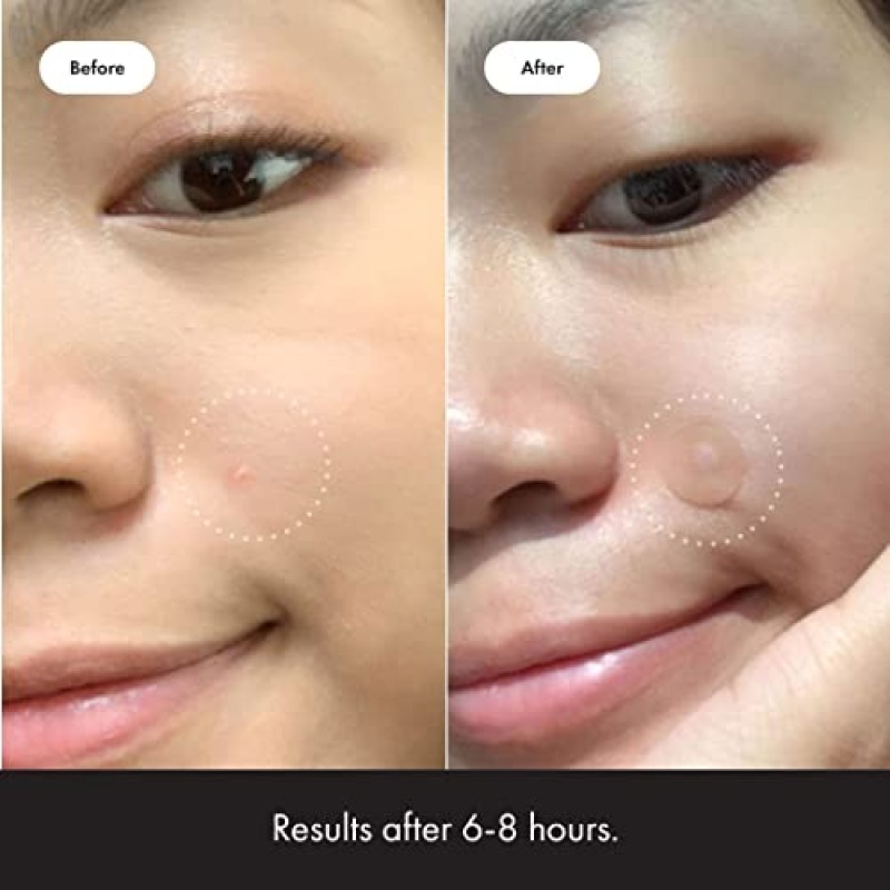 Hero Cosmetics의 Mighty Patch™ 오리지널 패치 - 여드름과 잡티를 덮는 하이드로콜로이드 여드름 여드름 패치, 얼굴과 피부용 스팟 스티커, 채식주의자 친화적이며 동물 테스트를 거치지 않음(36개)