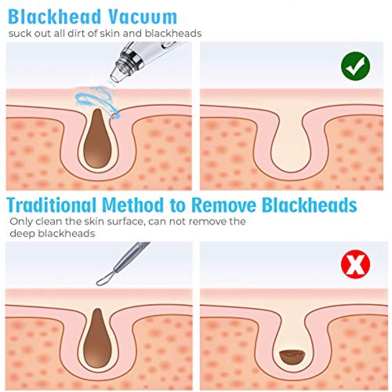 2023 업그레이드 블랙헤드 리무버 모공 진공, 페이셜 모공 클리너, 전기 코메도 화이트헤드 추출기 도구-5 흡입력, 5 프로브, 여성 및 남성용 블랙헤드 진공 키트