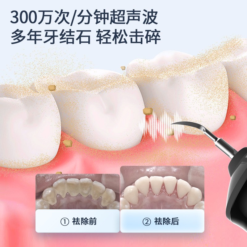 초음파 치아 세정기, 가정용 치석 제거 도구, 치아 청소용 청소 도구, 치석 제거 및 청소 도구