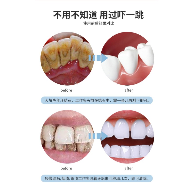 가정용 치석제거 가공물, 치아치석제거제, 치석제거 가공물, 치아청결 및 치석제거