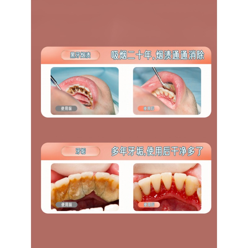 치아 미적분 제거를 위한 초음파 치과 스케일러, 가정용 전기 치과 스케일러, 치아 청소, 치아 세척 및 구강 치과용 특수
